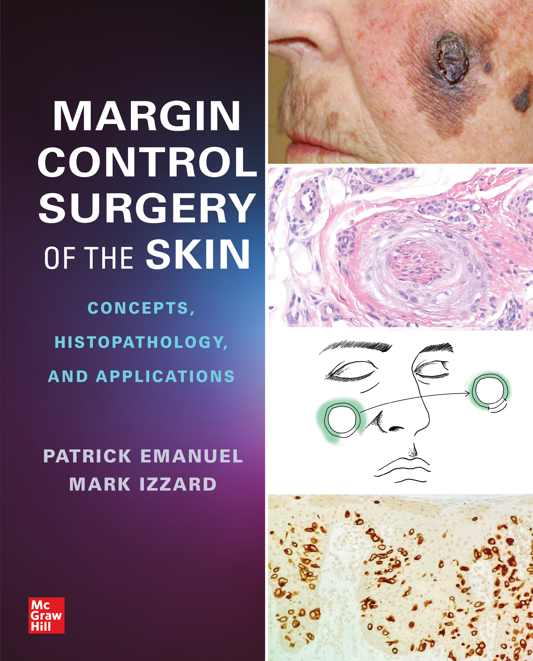 Cover image for Margin Control Surgery of the Skin: Concepts, Histopathology, and Applications