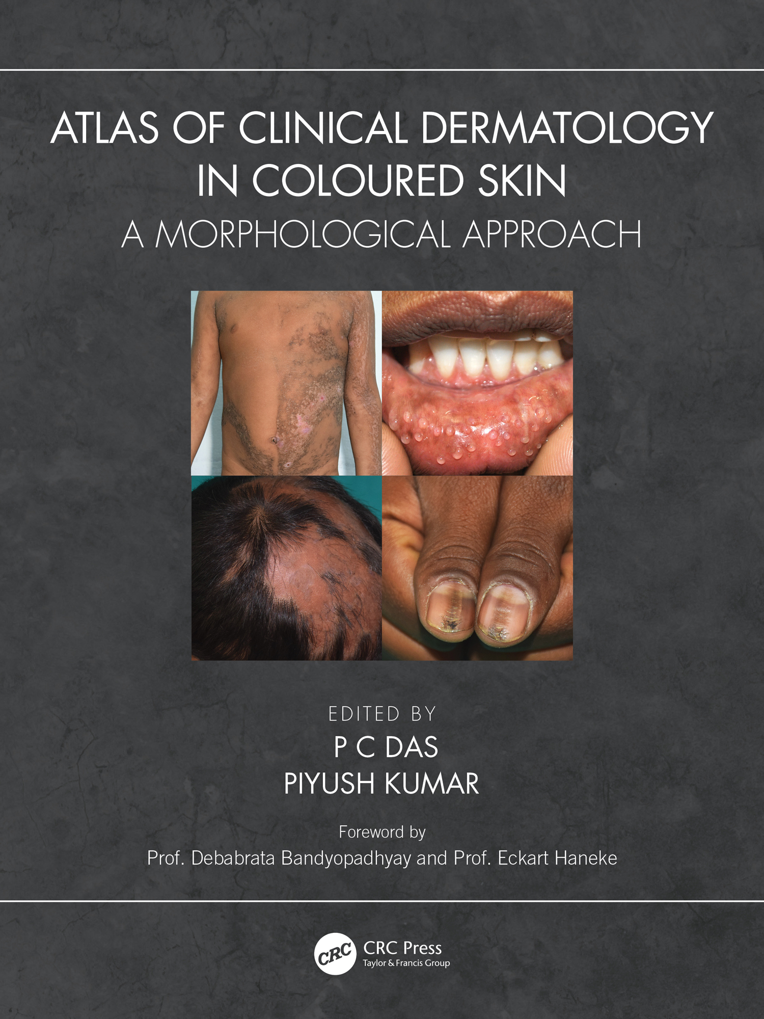 Cover image for Atlas of Clinical Dermatology in Coloured Skin