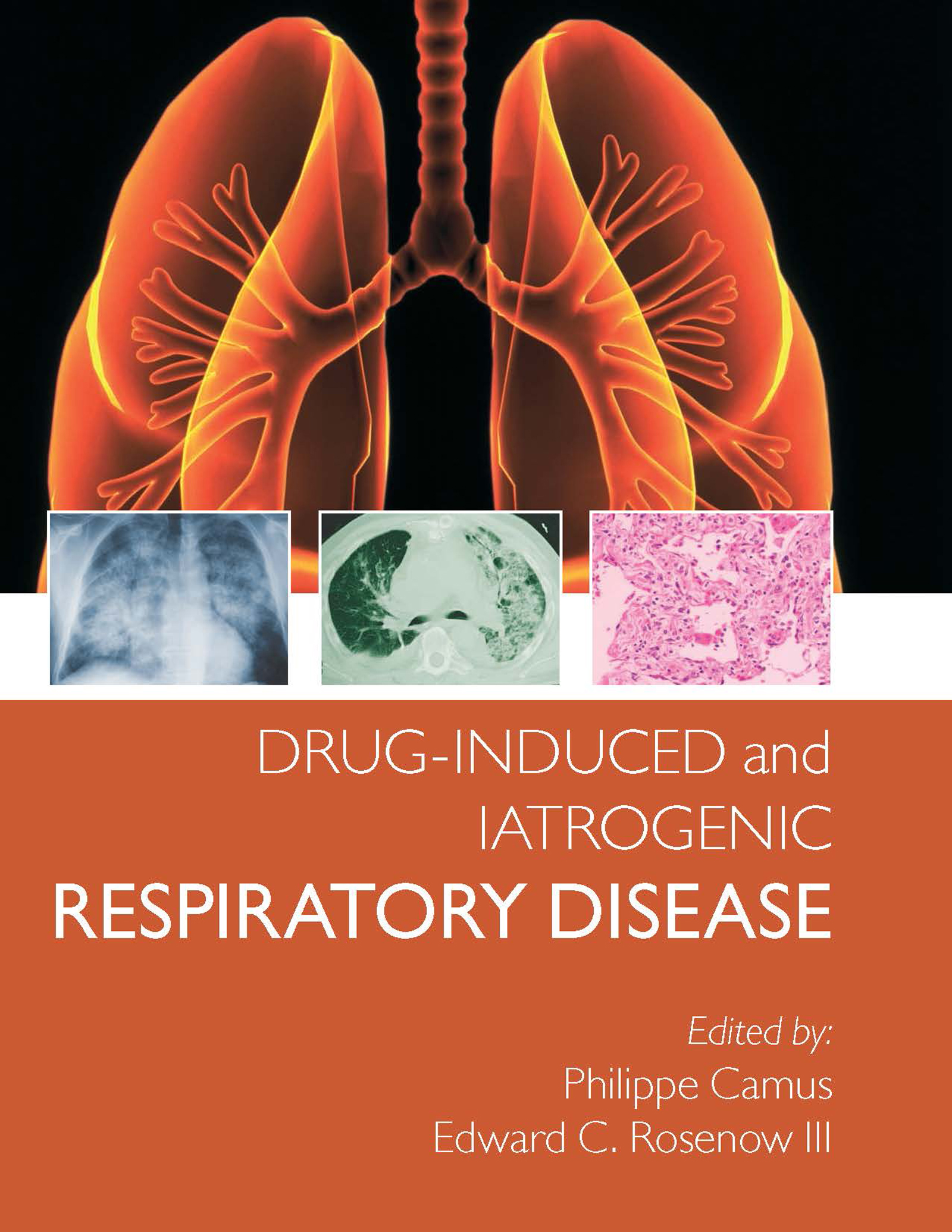Cover image for Drug-induced and Iatrogenic Respiratory Disease