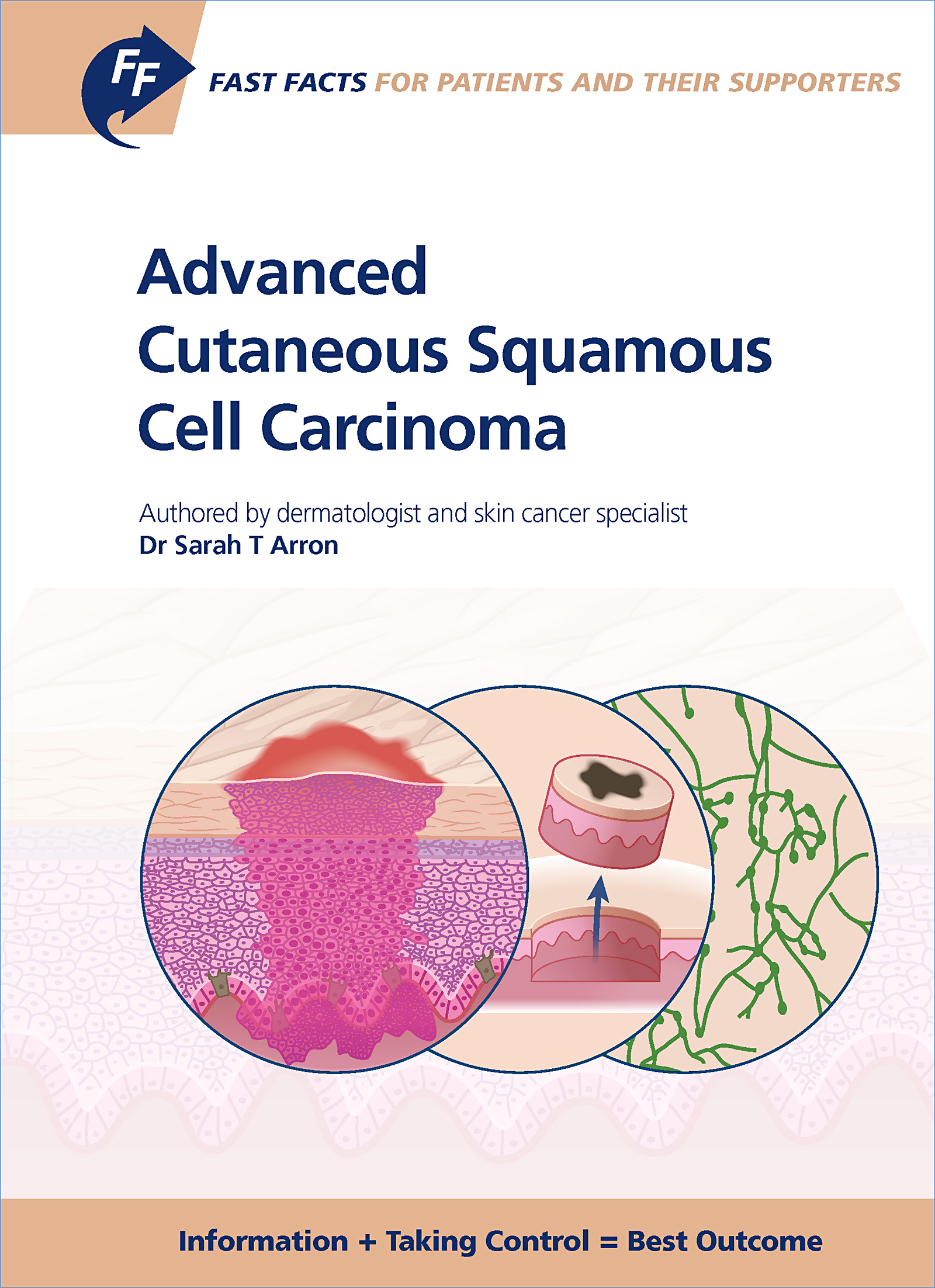 Cover image for Fast Facts: Advanced Cutaneous Squamous Cell Carcinoma for Patients and their Supporters