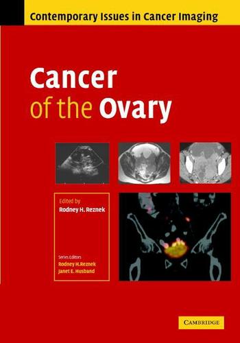 Cover image for Cancer of the Ovary