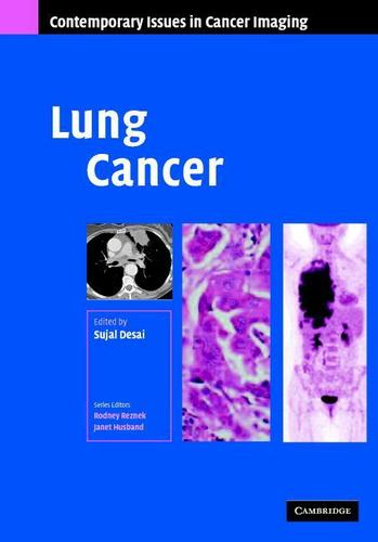 Cover image for Lung Cancer