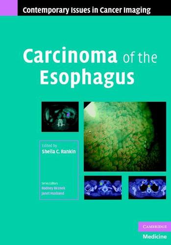 Cover image for Carcinoma of the Esophagus