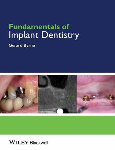 Cover image for Fundamentals of Implant Dentistry