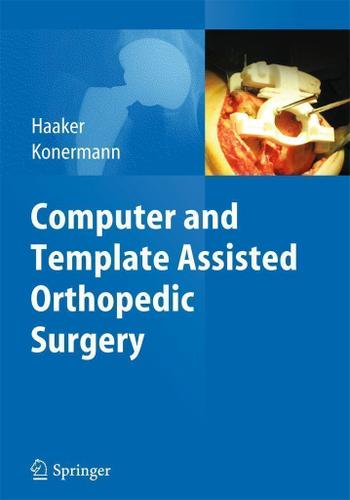 Cover image for Computer and Template Assisted Orthopedic Surgery
